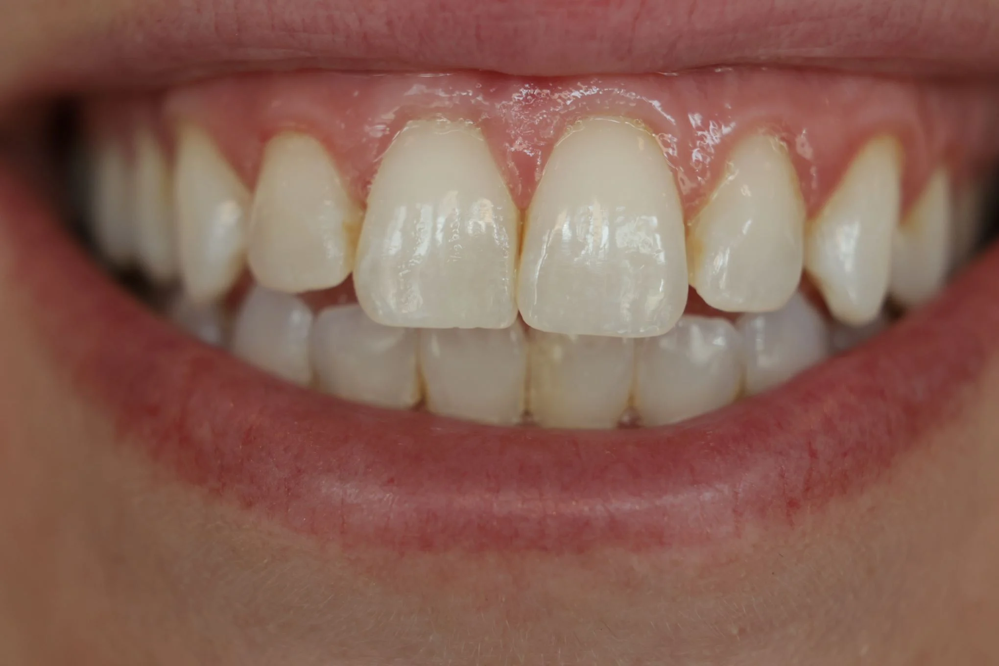 Estética dental antes