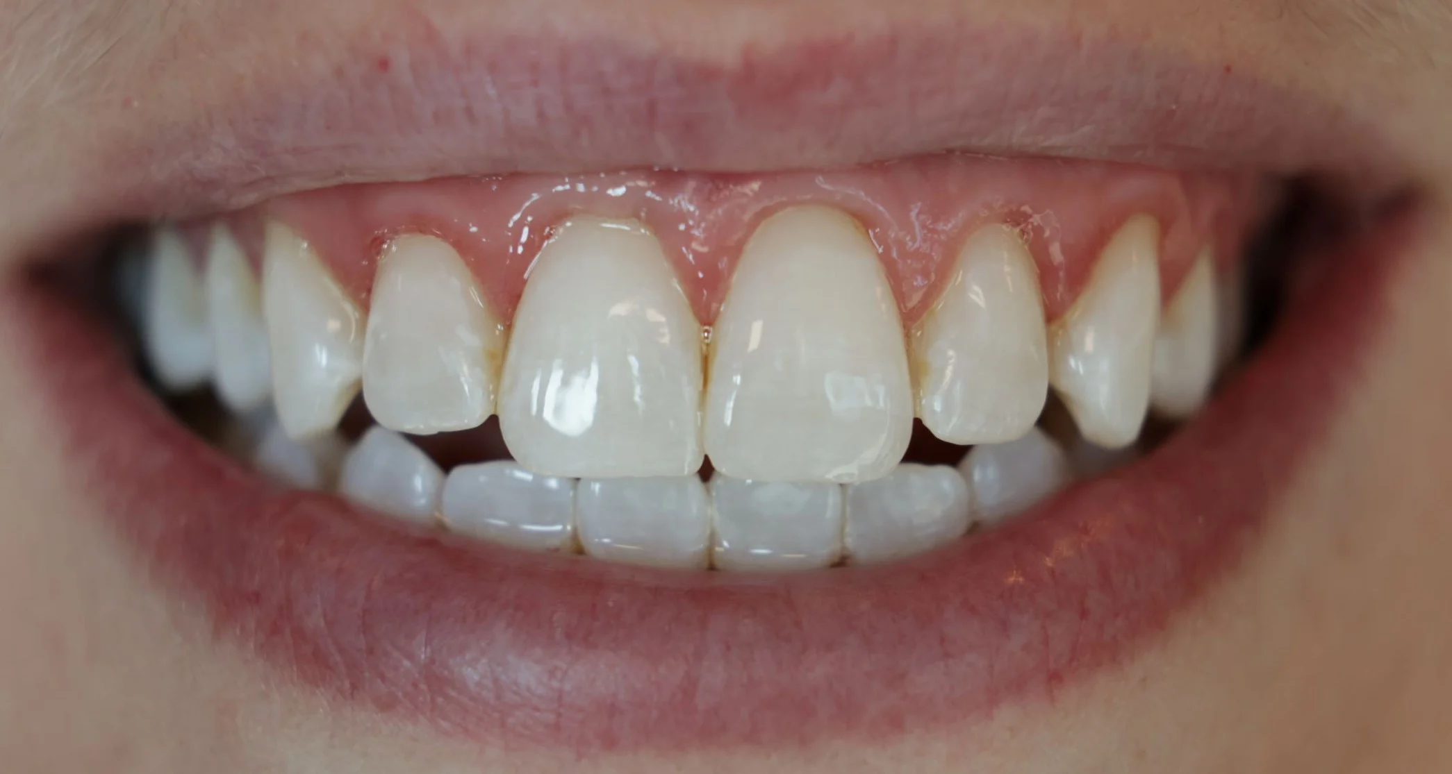 Estética dental después