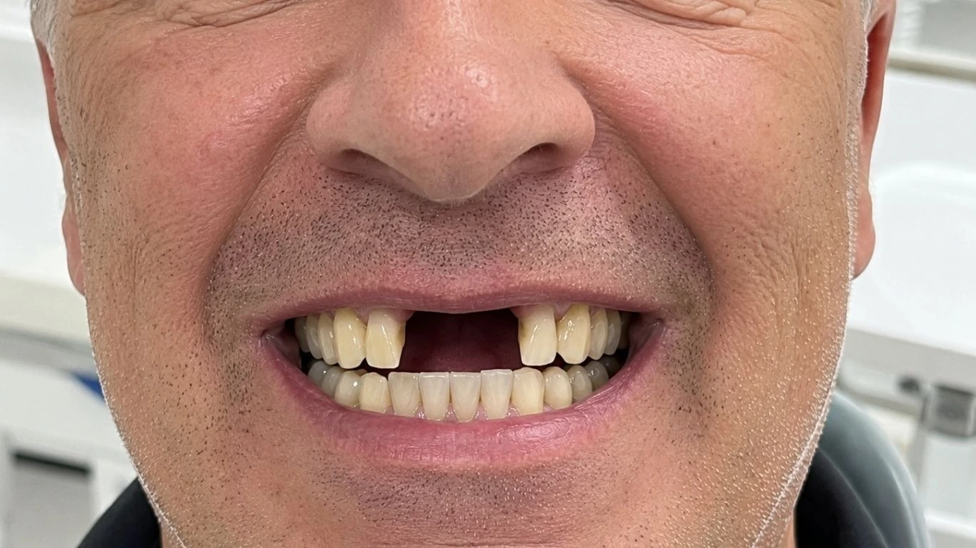 Implantes dentales antes